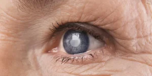 Gejala Awal Glaukoma yang Tidak Disadari Lansia